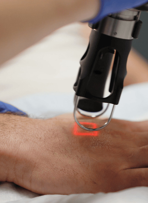 cool-peel-laser-resurfacing (1)