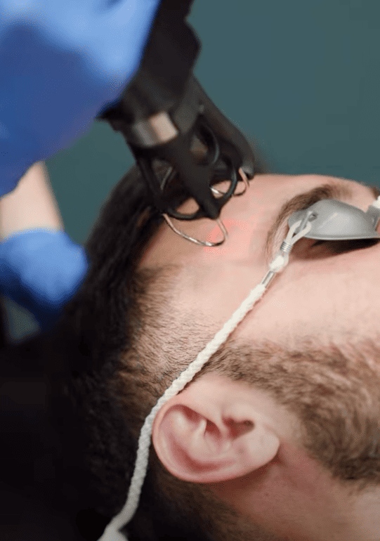coolpeel-laser-treatment-face-powell-ohio