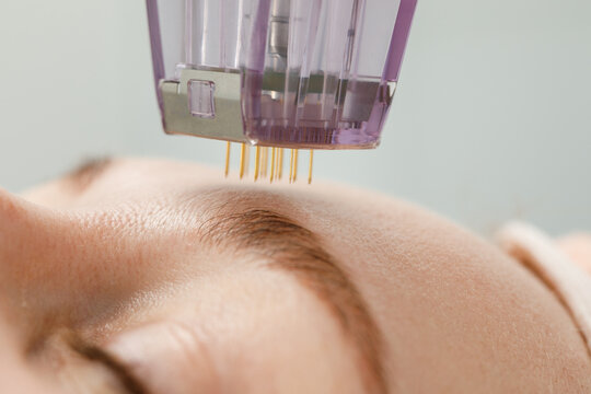 RF Microneedling Powell Ohio