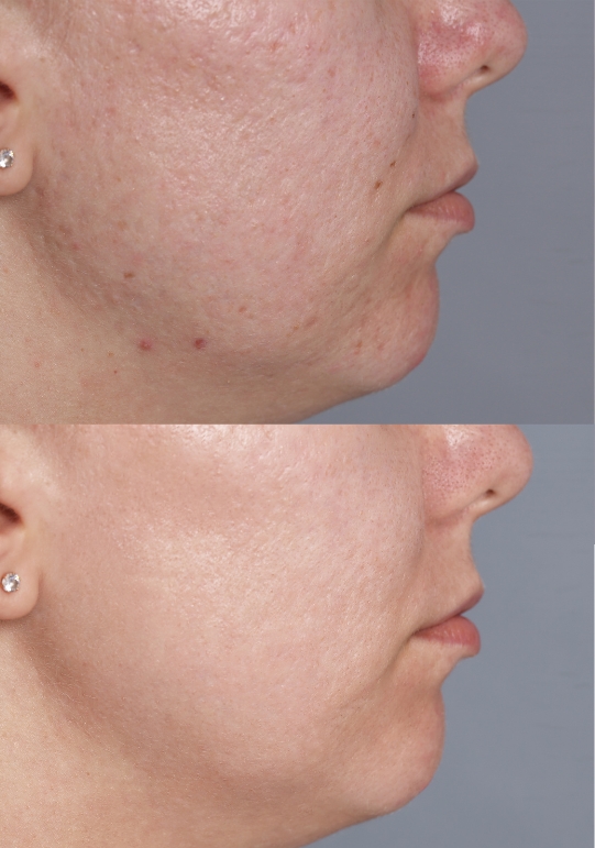 acne-scar-treatment