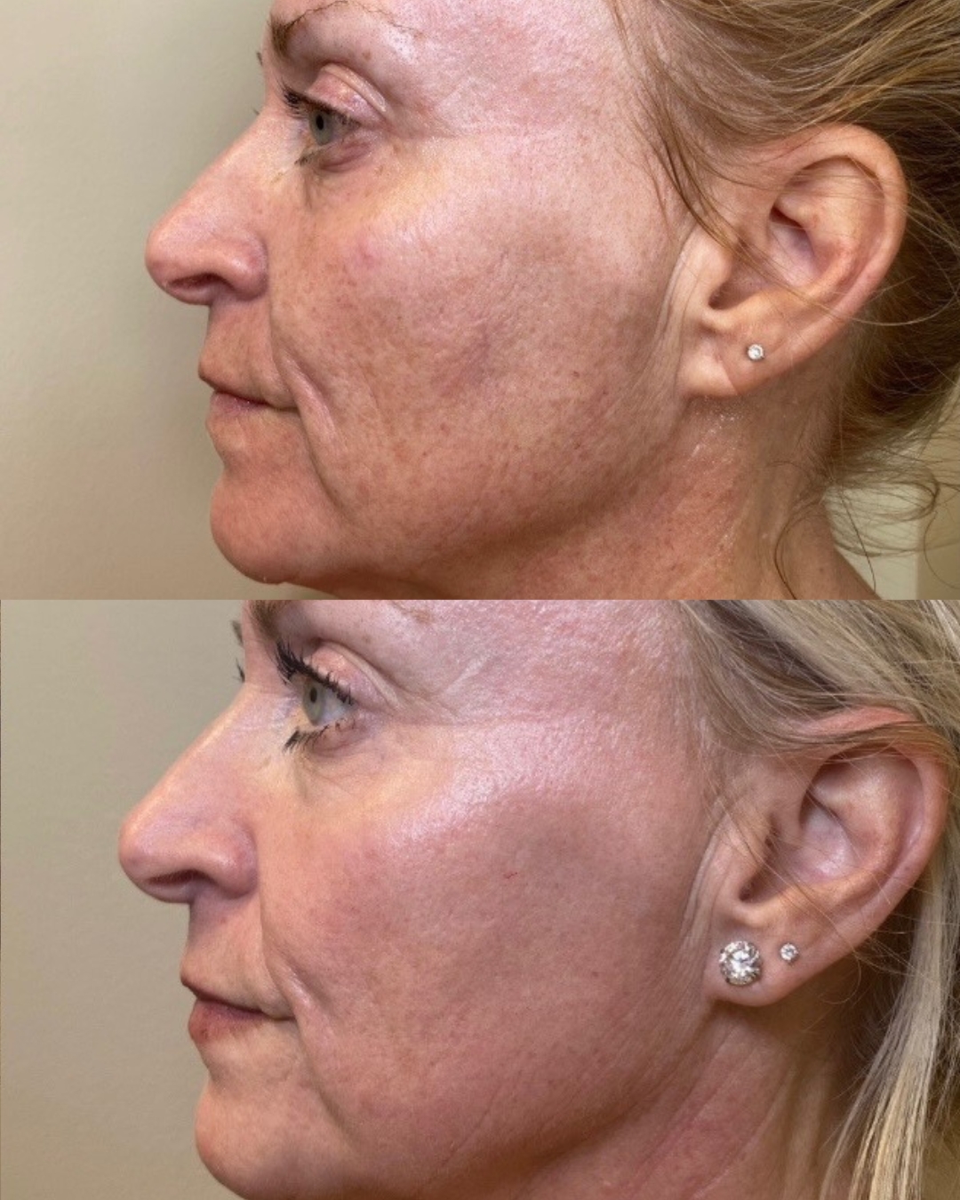 co2-laser-resurfacing